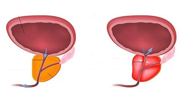 Healthy and inflamed prostate