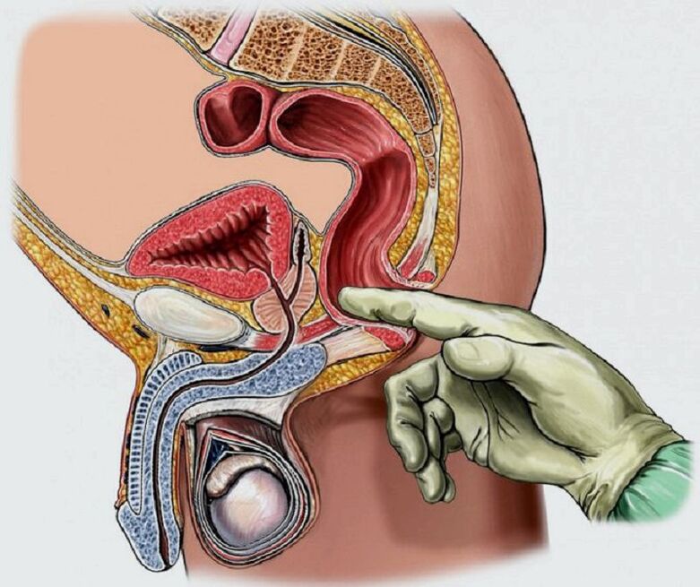 Prostate massage for prostatitis